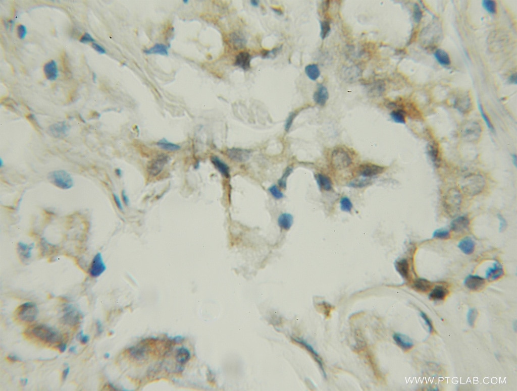 Immunohistochemistry (IHC) staining of human prostate cancer tissue using PDE9A Polyclonal antibody (12648-1-AP)