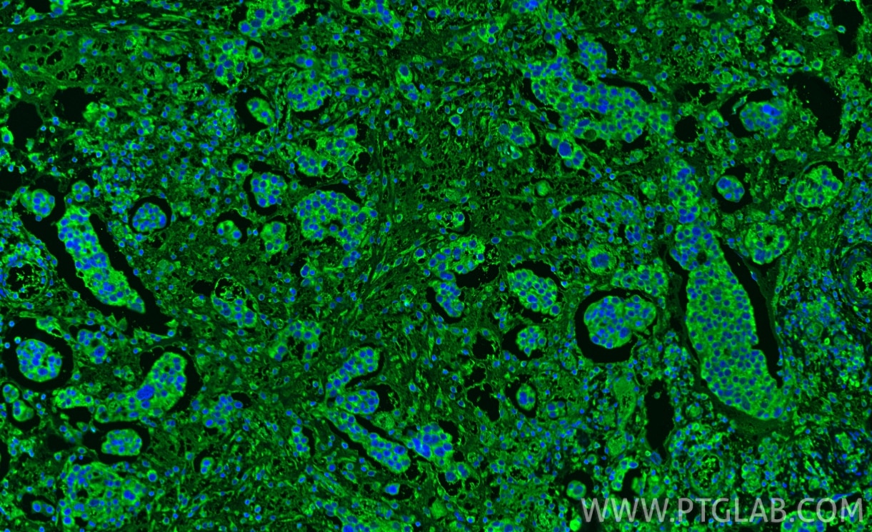 Immunofluorescence (IF) / fluorescent staining of human ovary cancer tissue using PDF Polyclonal antibody (24842-1-AP)