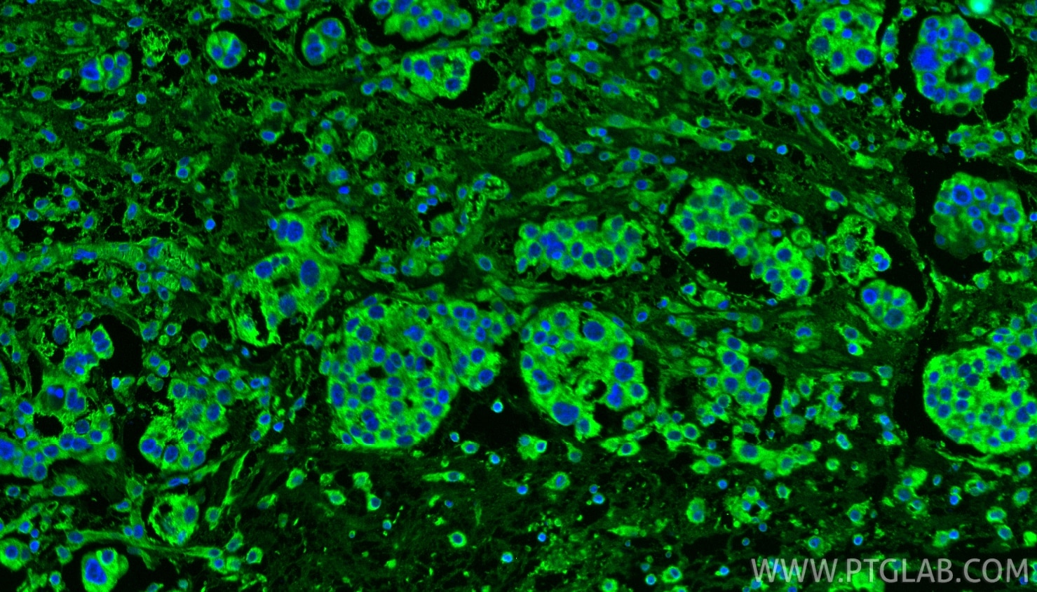 Immunofluorescence (IF) / fluorescent staining of human ovary cancer tissue using PDF Polyclonal antibody (24842-1-AP)