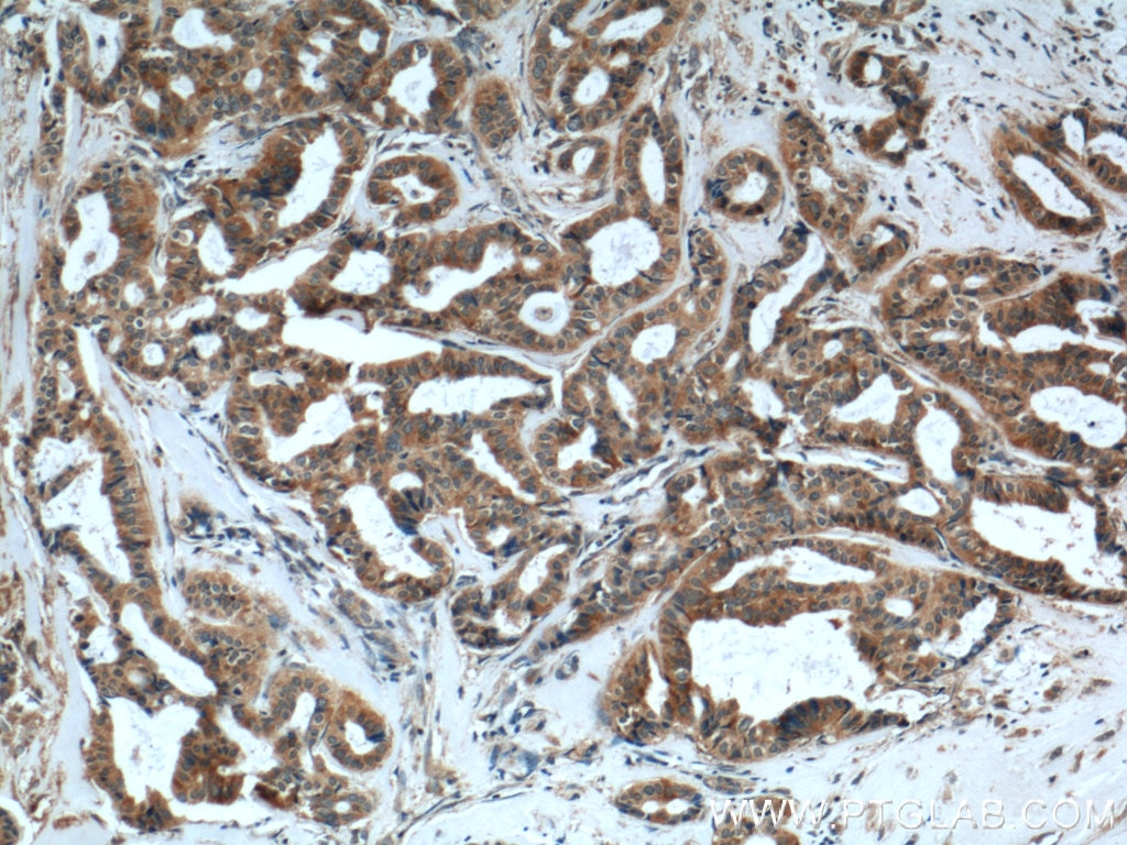 Immunohistochemistry (IHC) staining of human breast cancer tissue using PDF Polyclonal antibody (24842-1-AP)