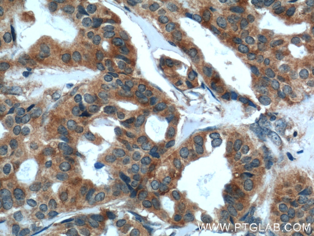 Immunohistochemistry (IHC) staining of human breast cancer tissue using PDF Polyclonal antibody (24842-1-AP)