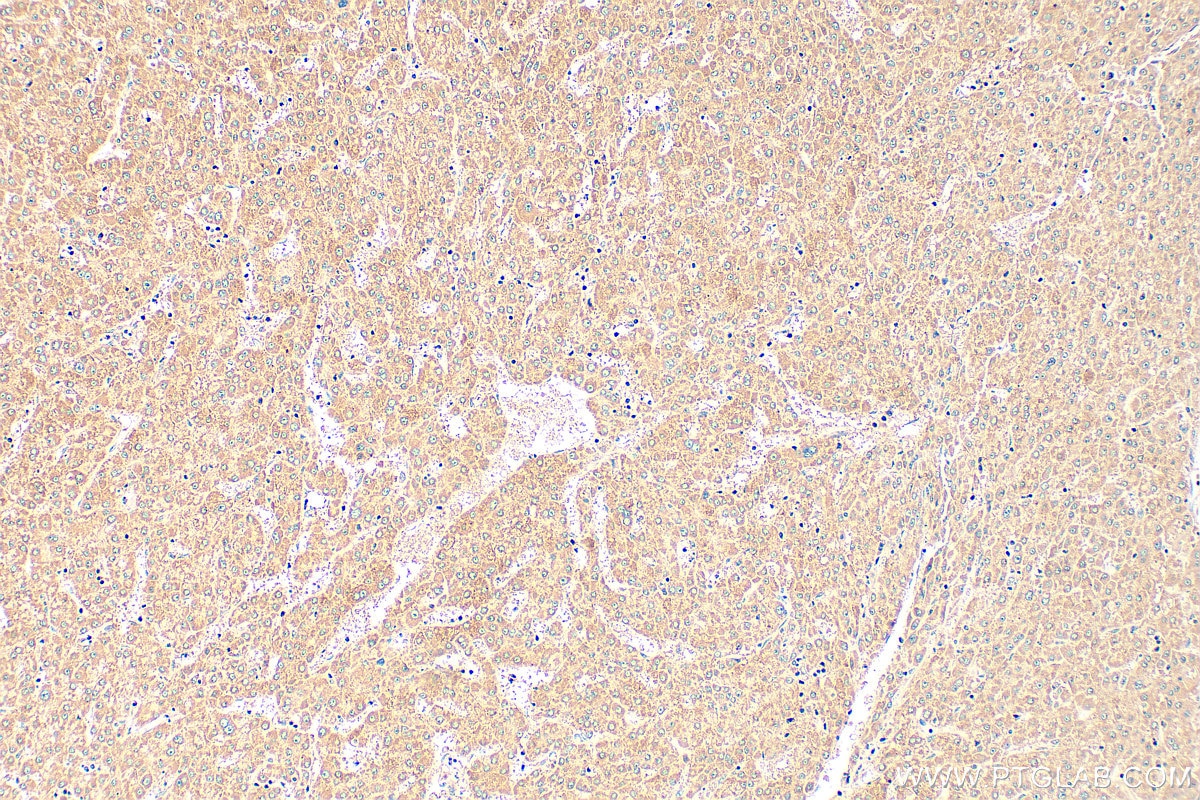Immunohistochemistry (IHC) staining of human liver cancer tissue using PDF Polyclonal antibody (24842-1-AP)