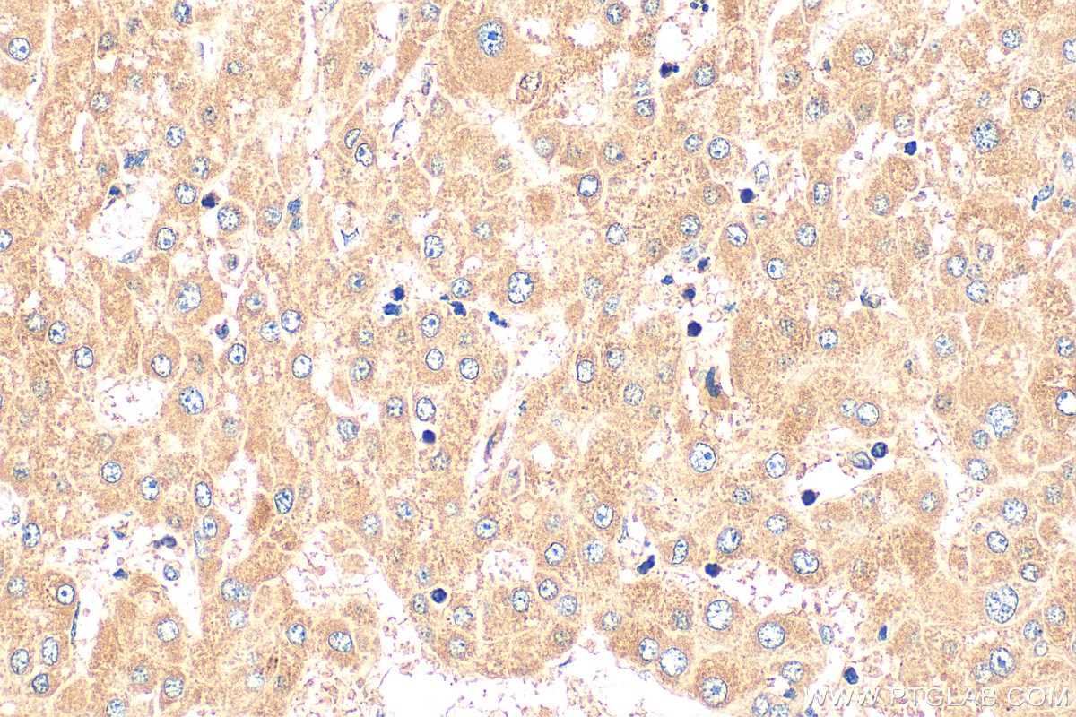 Immunohistochemistry (IHC) staining of human liver cancer tissue using PDF Polyclonal antibody (24842-1-AP)