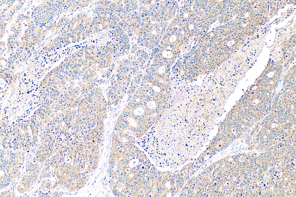 Immunohistochemistry (IHC) staining of human ovary tumor tissue using PDF Polyclonal antibody (24842-1-AP)