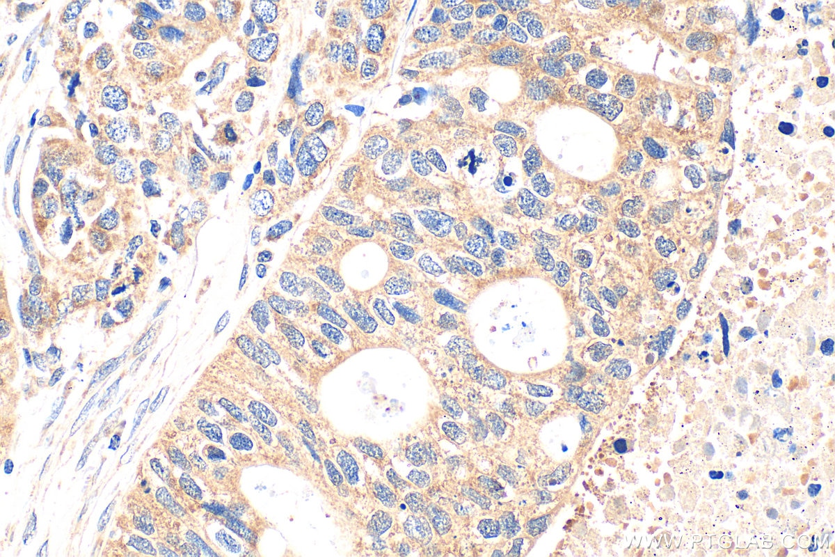 Immunohistochemistry (IHC) staining of human ovary tumor tissue using PDF Polyclonal antibody (24842-1-AP)