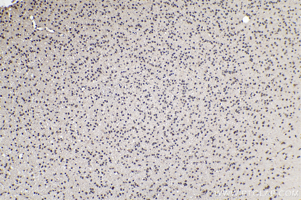 Immunohistochemistry (IHC) staining of human gliomas tissue using PDGFC Polyclonal antibody (55076-1-AP)