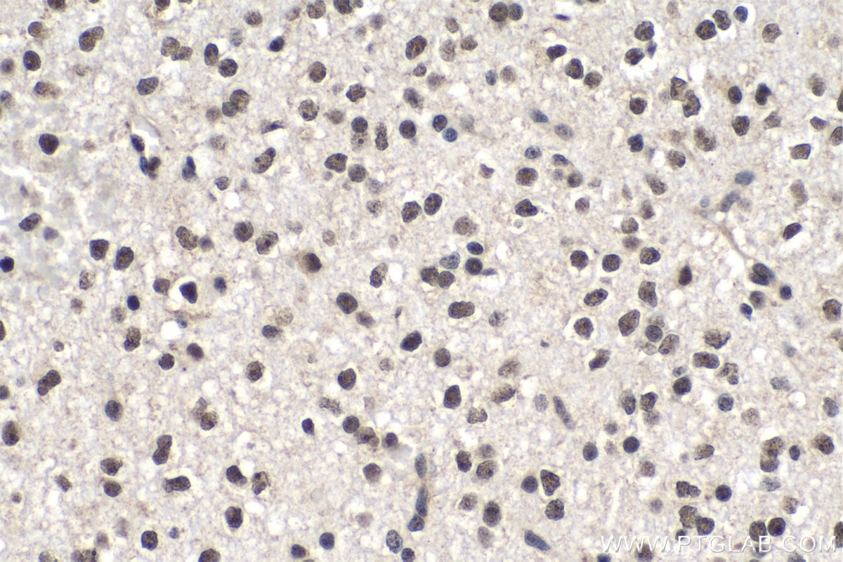 Immunohistochemistry (IHC) staining of human gliomas tissue using PDGFC Polyclonal antibody (55076-1-AP)