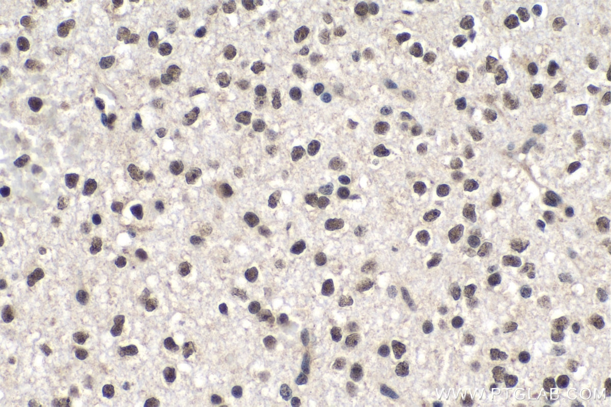 IHC staining of human gliomas using 55076-1-AP