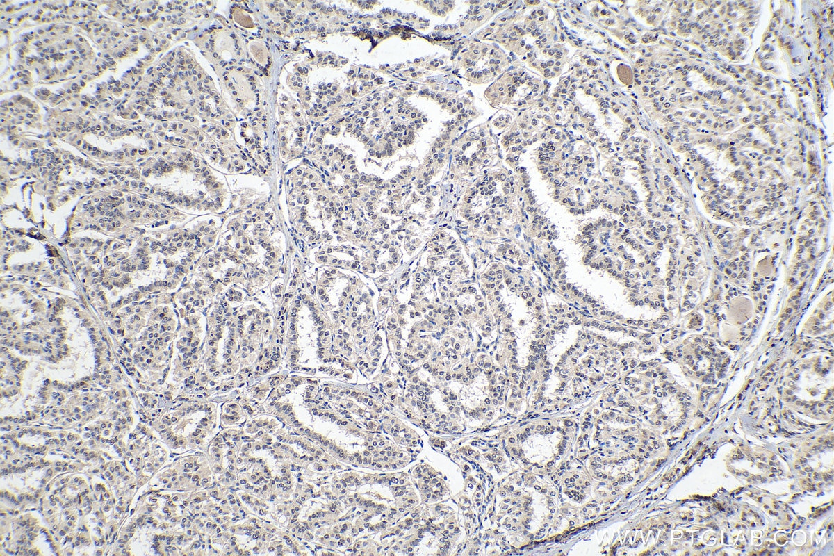 Immunohistochemistry (IHC) staining of human thyroid cancer tissue using PDGFC Polyclonal antibody (55076-1-AP)
