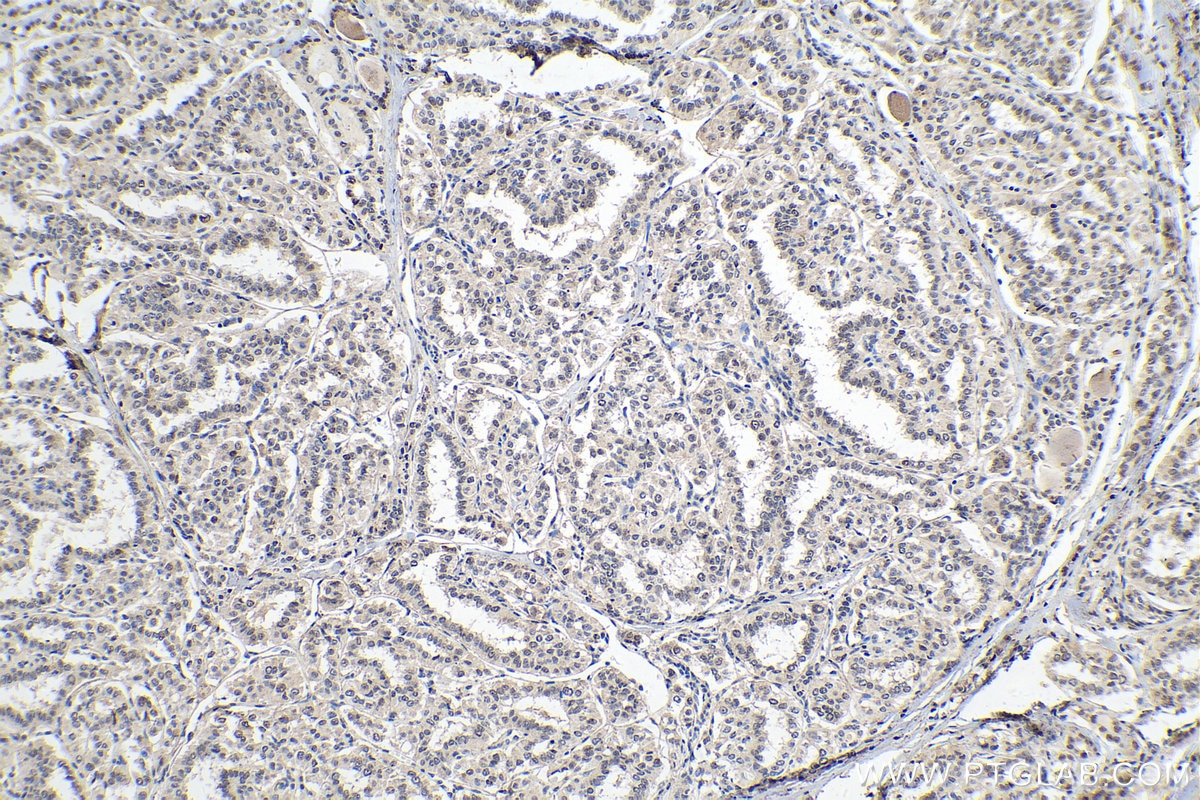 IHC staining of human thyroid cancer using 55076-1-AP