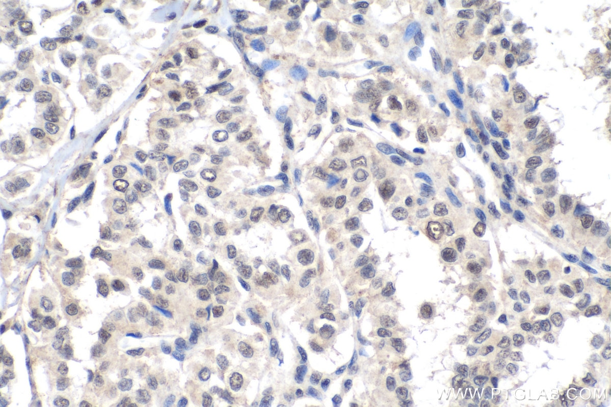 Immunohistochemistry (IHC) staining of human thyroid cancer tissue using PDGFC Polyclonal antibody (55076-1-AP)