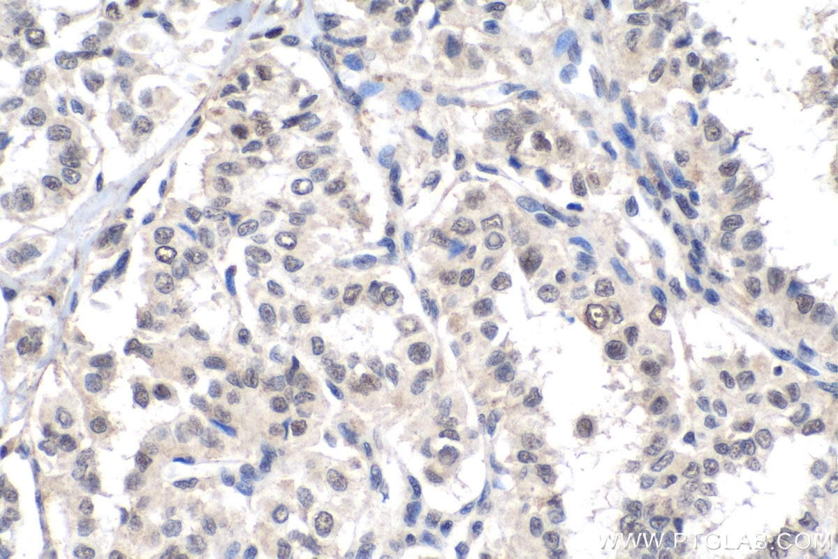 IHC staining of human thyroid cancer using 55076-1-AP