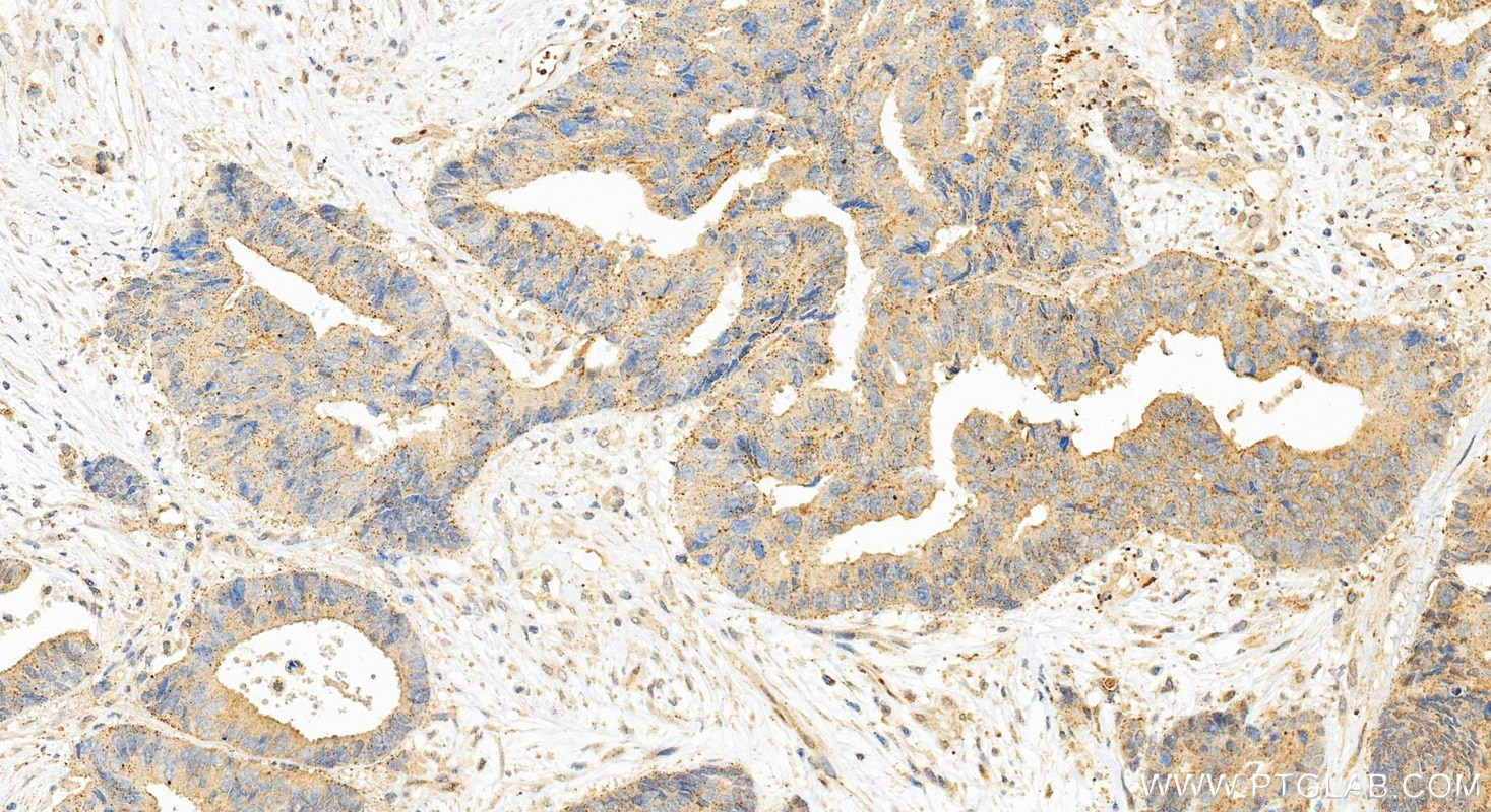 Immunohistochemistry (IHC) staining of human colon cancer tissue using PDGF-D Polyclonal antibody (14075-1-AP)