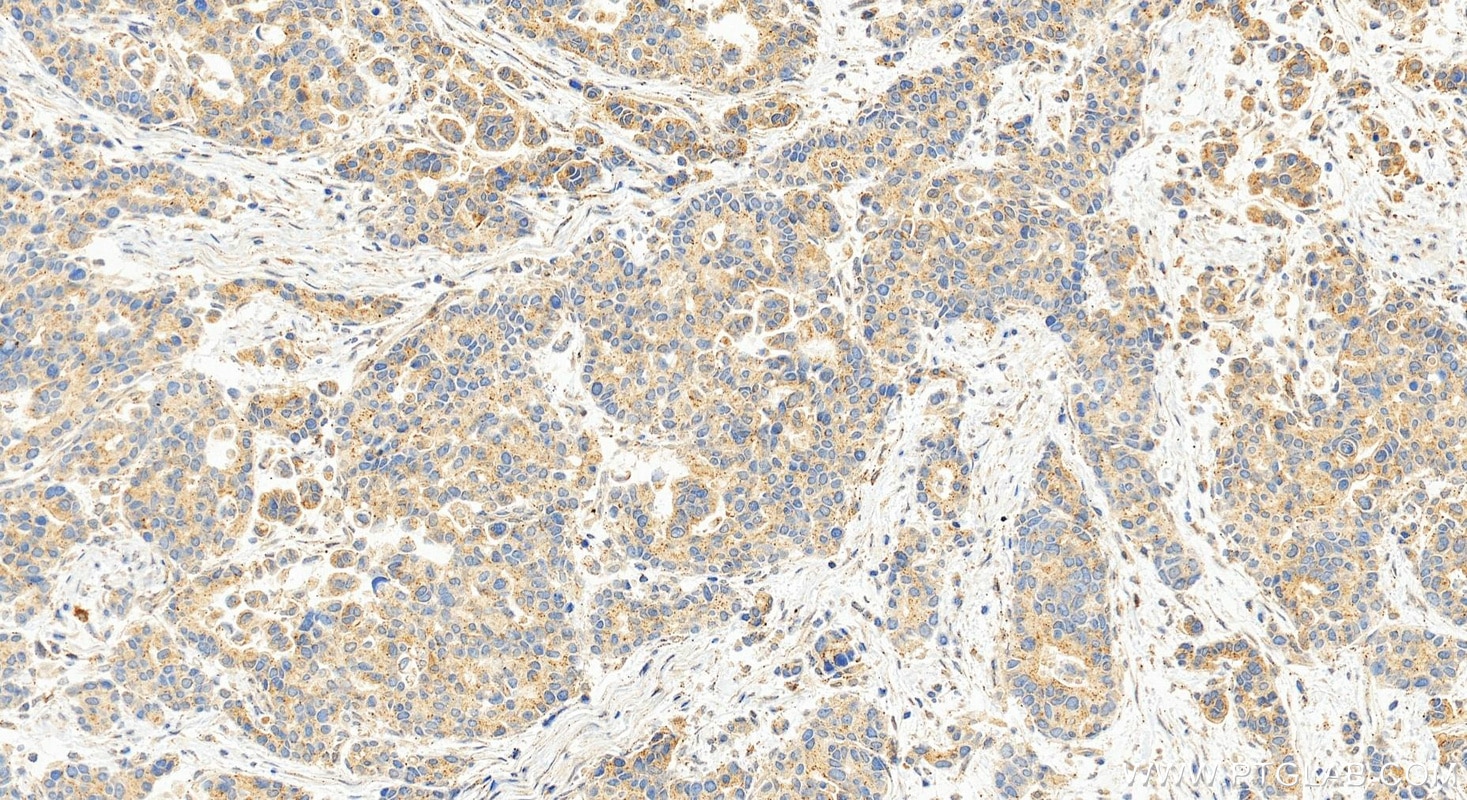 Immunohistochemistry (IHC) staining of human stomach cancer tissue using PDGF-D Polyclonal antibody (14075-1-AP)