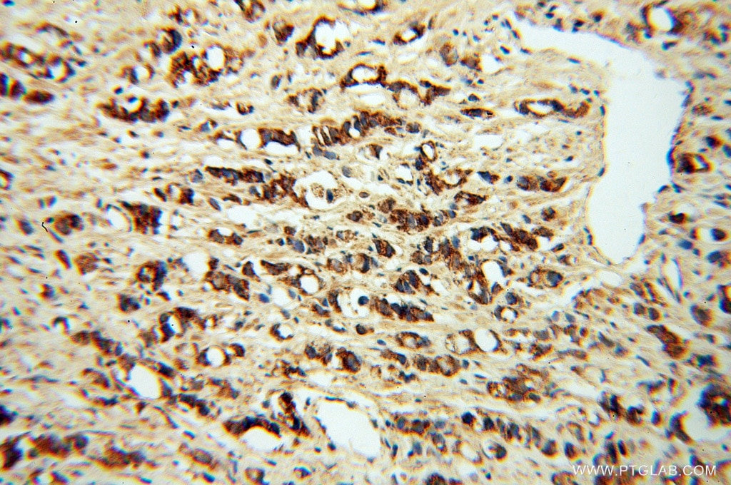 Immunohistochemistry (IHC) staining of human prostate cancer tissue using PDGFD Polyclonal antibody (14075-1-AP)