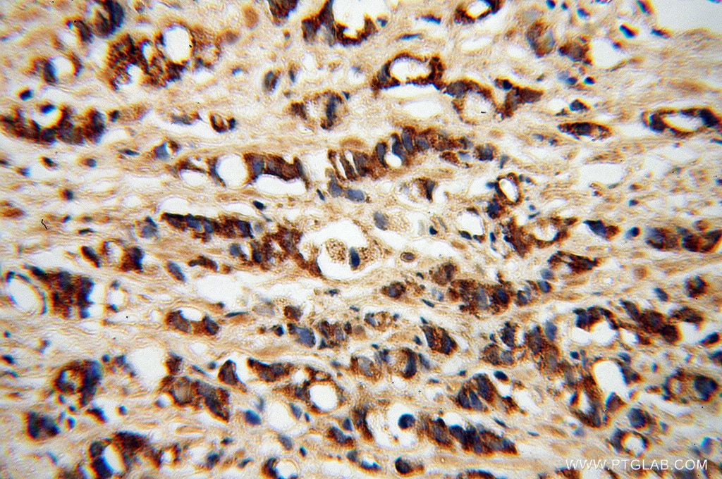 IHC staining of human prostate cancer using 14075-1-AP