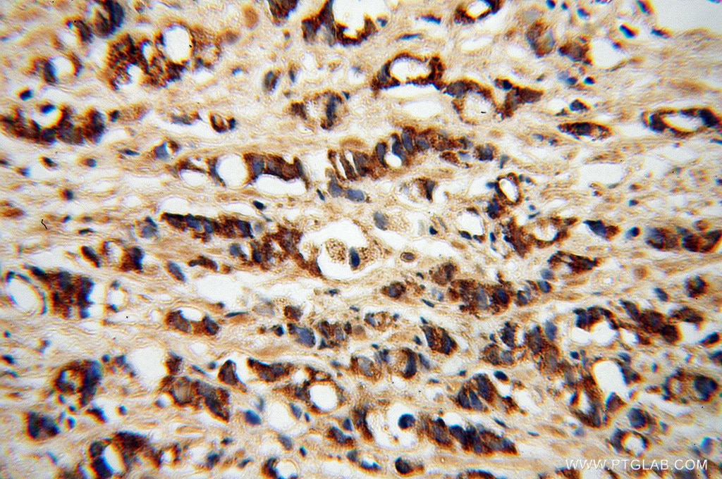 Immunohistochemistry (IHC) staining of human prostate cancer tissue using PDGFD Polyclonal antibody (14075-1-AP)