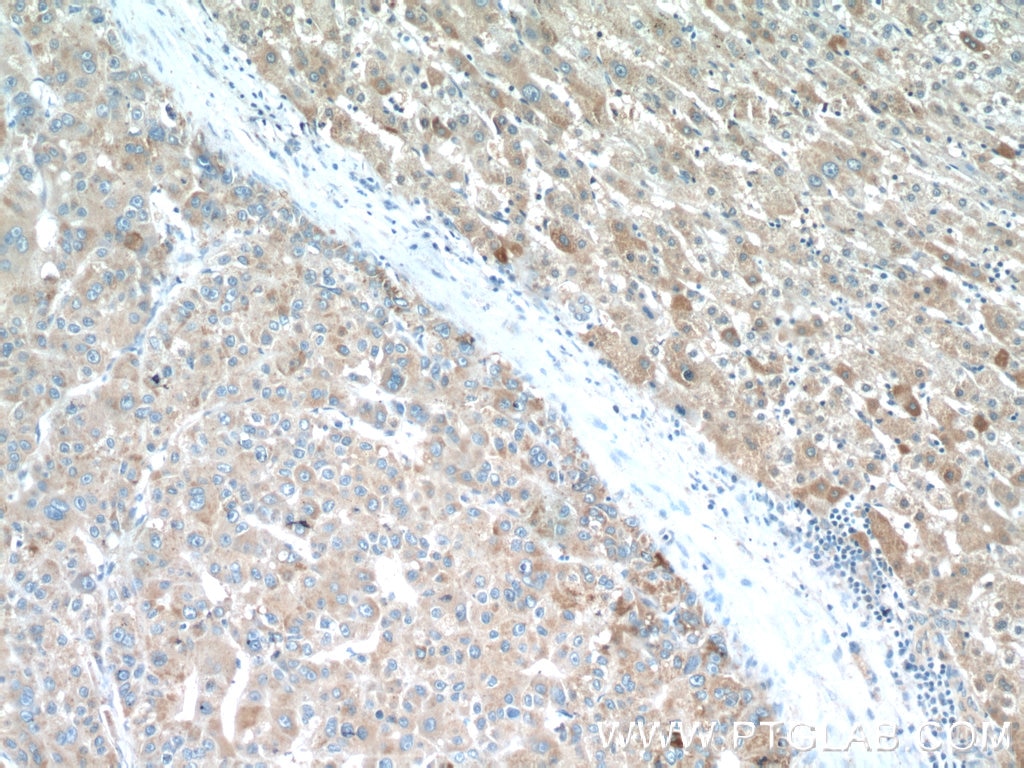 IHC staining of human liver cancer using 16217-1-AP