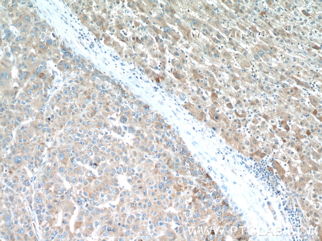 Immunohistochemistry (IHC) staining of human liver cancer tissue using PDGFRL Polyclonal antibody (16217-1-AP)