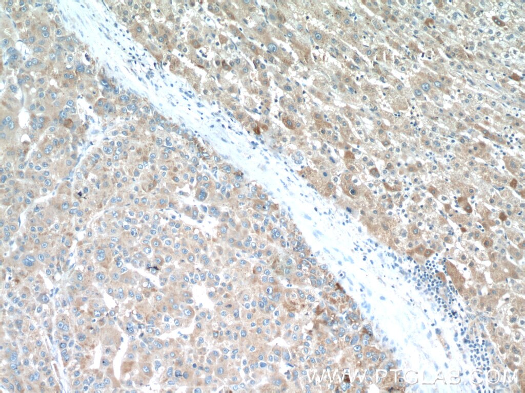 Immunohistochemistry (IHC) staining of human liver cancer tissue using PDGFRL Polyclonal antibody (16217-1-AP)