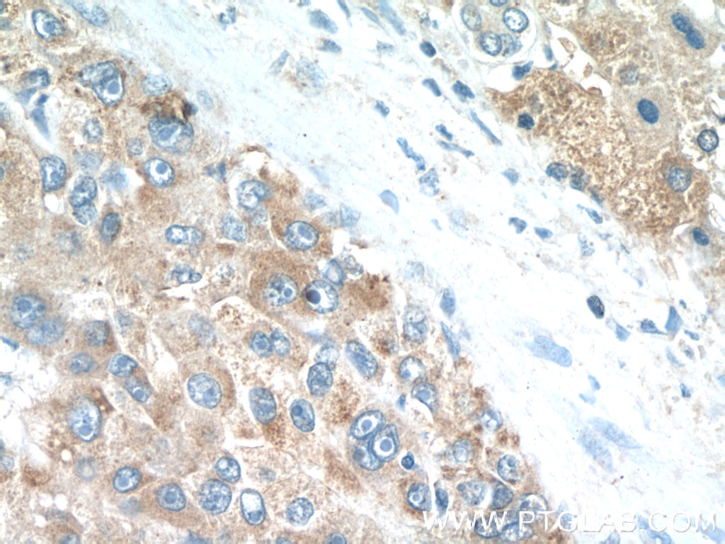 Immunohistochemistry (IHC) staining of human liver cancer tissue using PDGFRL Polyclonal antibody (16217-1-AP)
