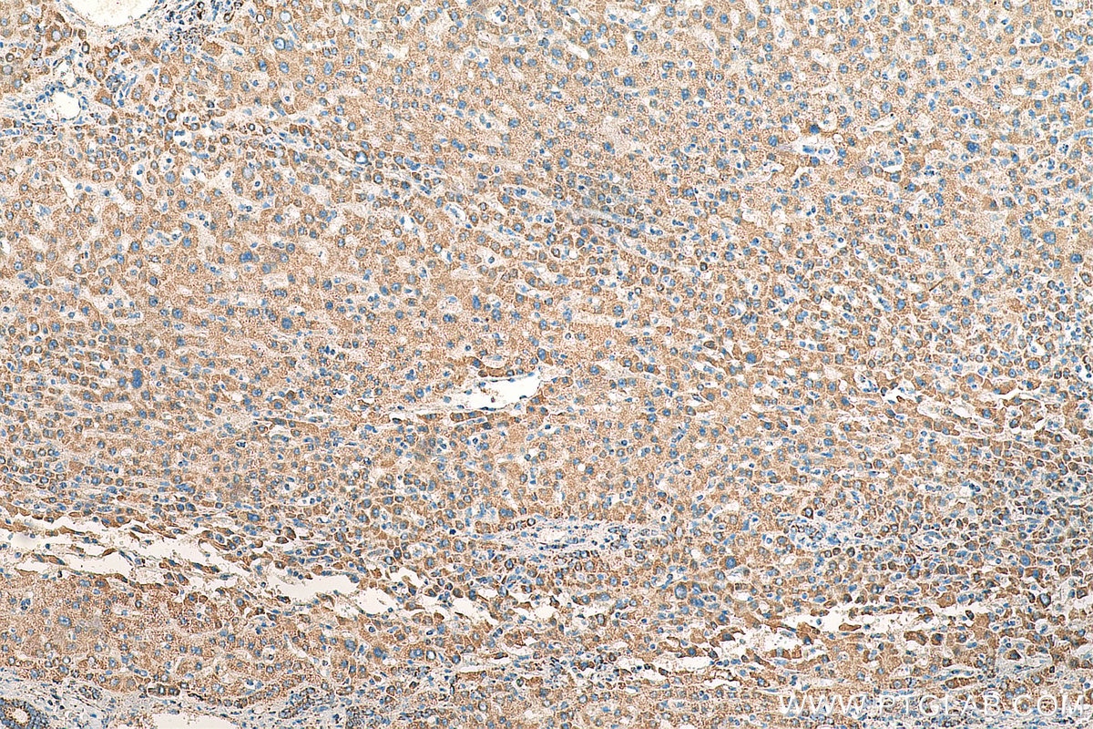 Immunohistochemistry (IHC) staining of human liver cancer tissue using PDH E1 Alpha Polyclonal antibody (18068-1-AP)