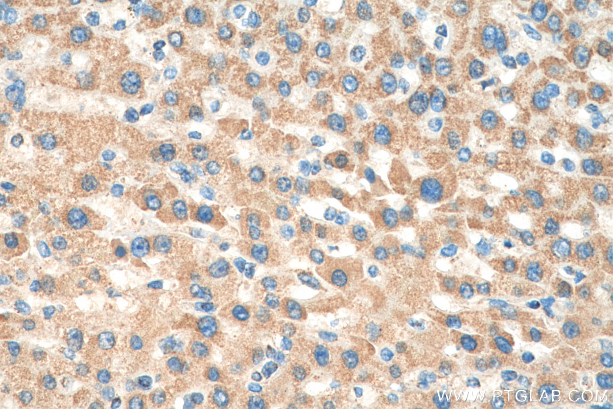 IHC staining of human liver cancer using 18068-1-AP