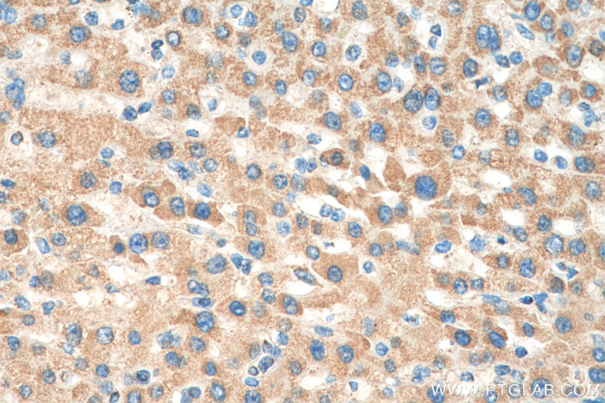 Immunohistochemistry (IHC) staining of human liver cancer tissue using PDH E1 Alpha Polyclonal antibody (18068-1-AP)