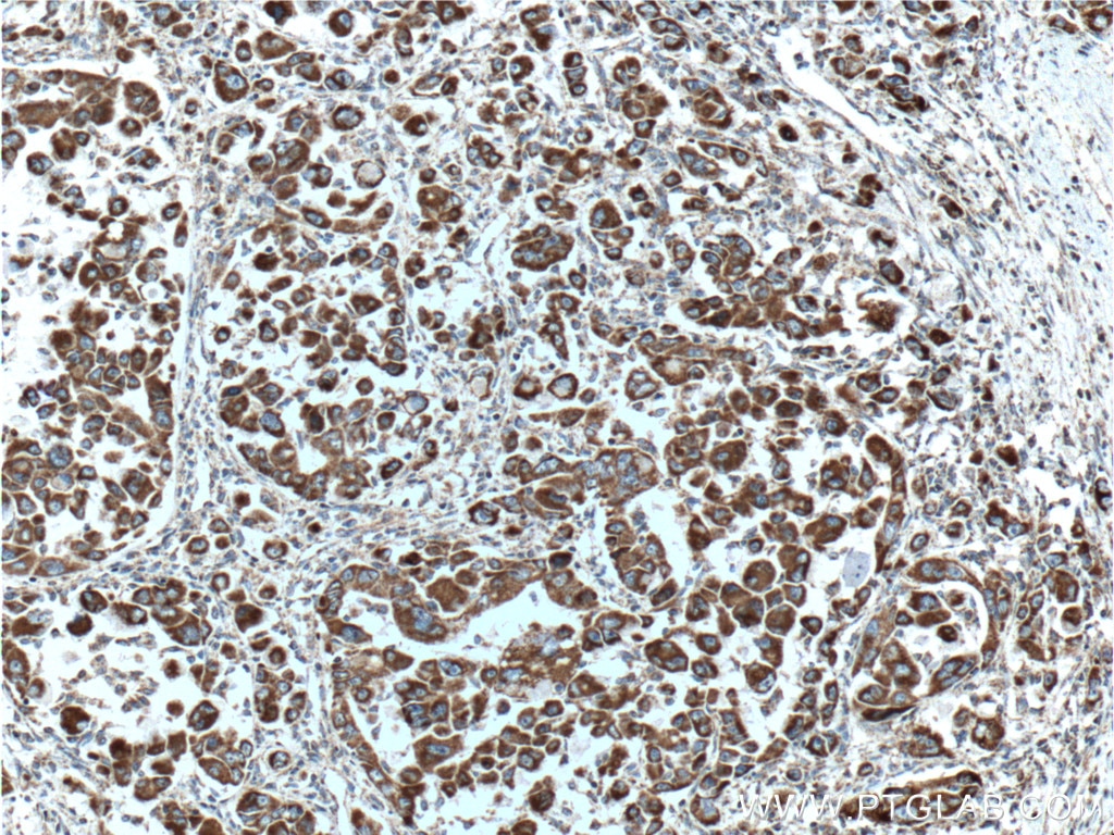 Immunohistochemistry (IHC) staining of human liver cancer tissue using PDH E1 Alpha Monoclonal antibody (66119-1-Ig)