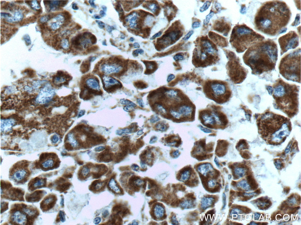 Immunohistochemistry (IHC) staining of human liver cancer tissue using PDH E1 Alpha Monoclonal antibody (66119-1-Ig)