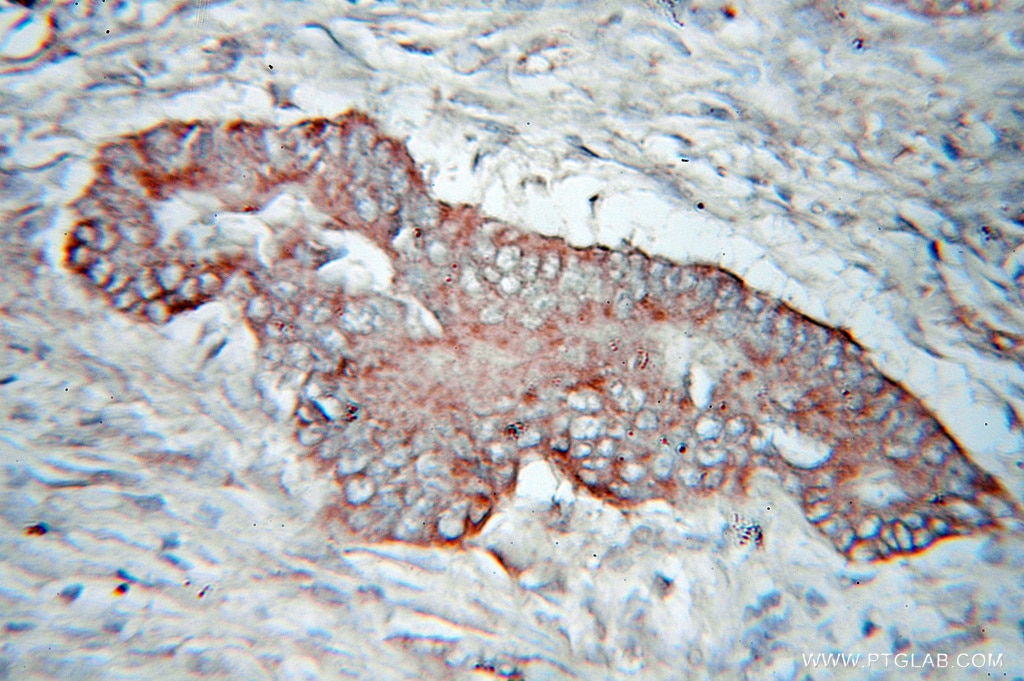 Immunohistochemistry (IHC) staining of human colon cancer tissue using PDHX Polyclonal antibody (10951-1-AP)