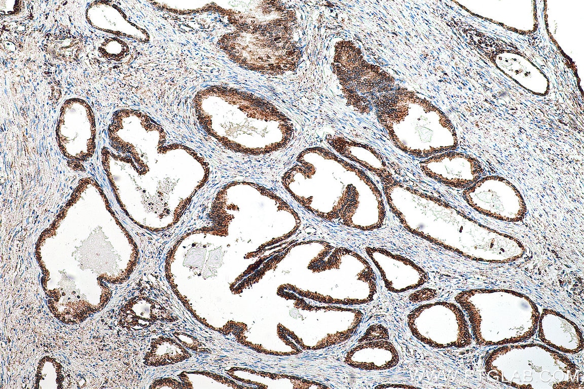 Immunohistochemistry (IHC) staining of human prostate cancer tissue using PDI Recombinant antibody (80170-1-RR)