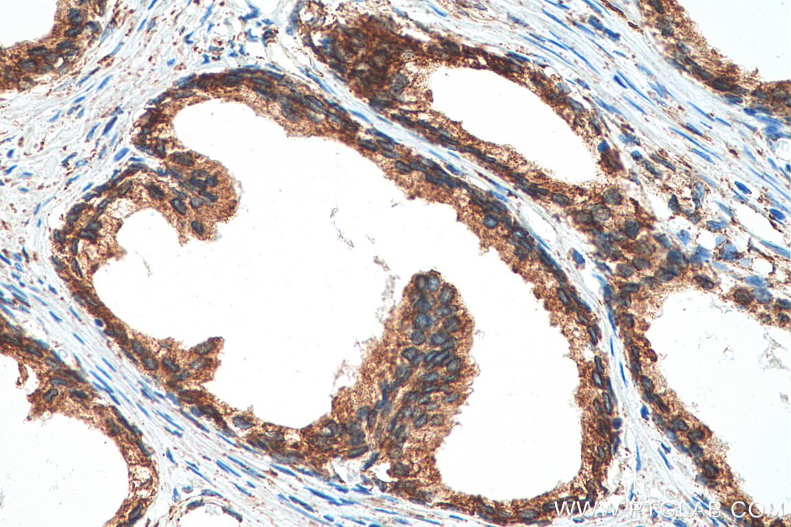 Immunohistochemistry (IHC) staining of human prostate cancer tissue using PDI Recombinant antibody (80170-1-RR)