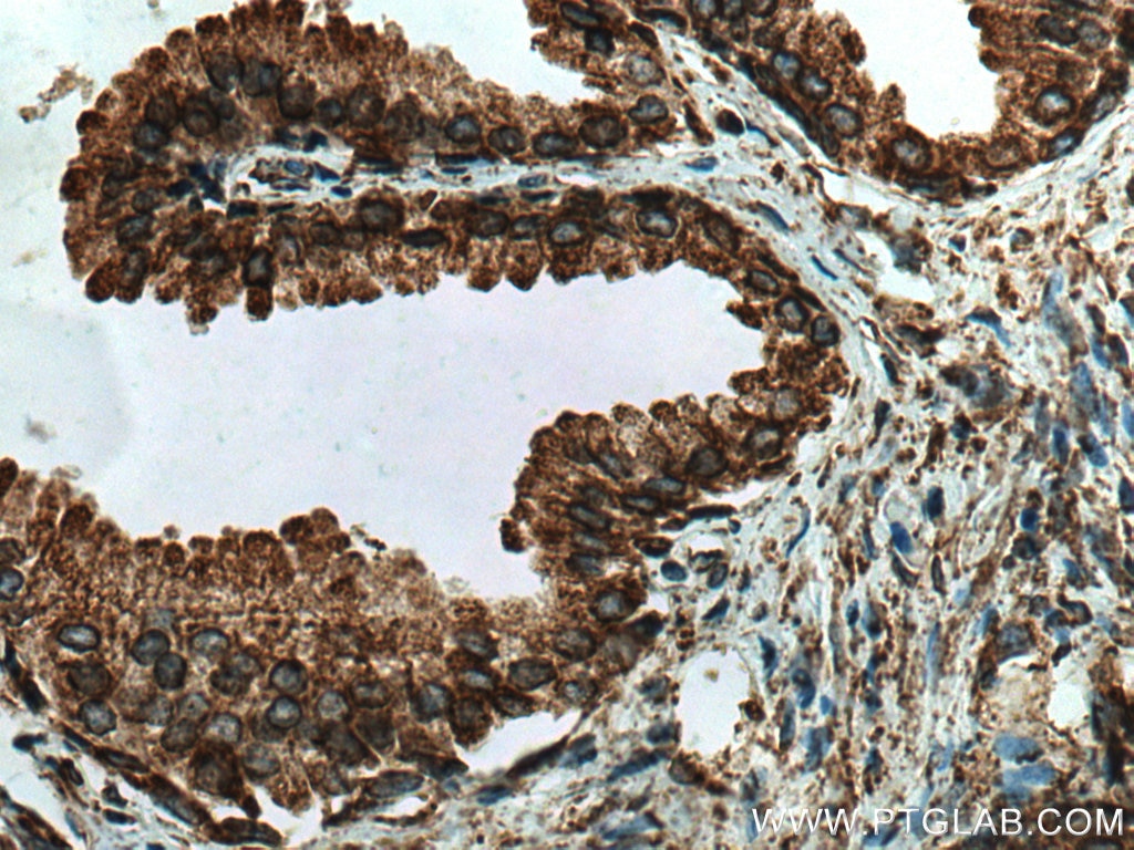 Immunohistochemistry (IHC) staining of human prostate cancer tissue using PDI Polyclonal antibody (11245-1-AP)