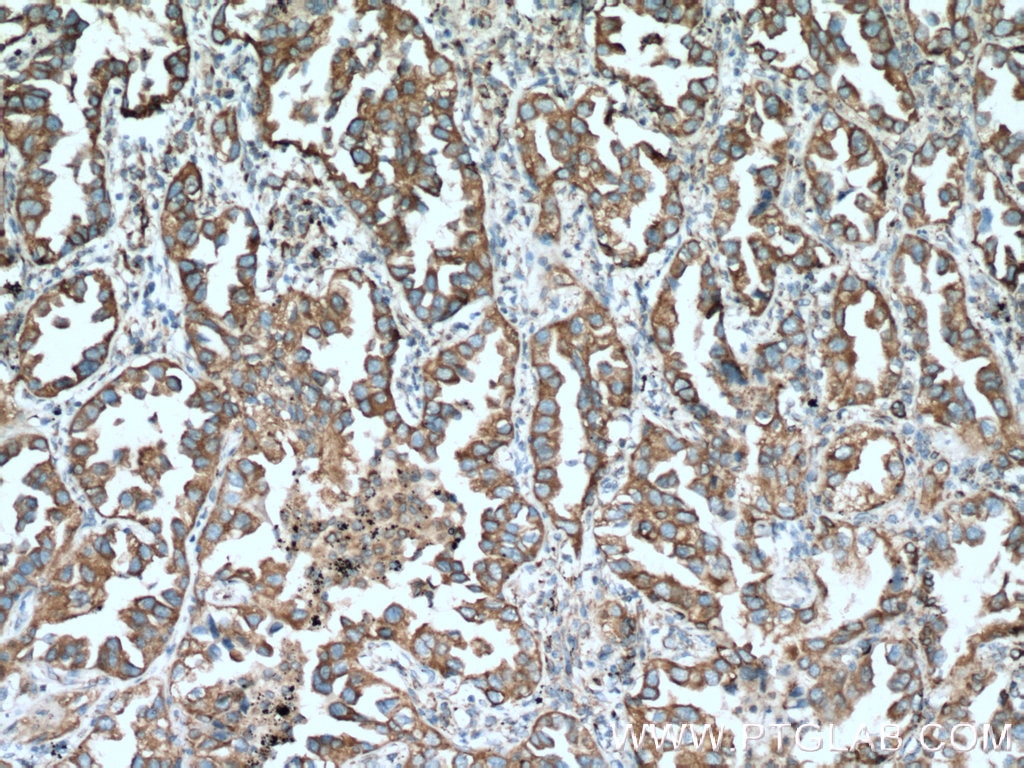 Immunohistochemistry (IHC) staining of human lung cancer tissue using ERp57/ERp60 Polyclonal antibody (15967-1-AP)