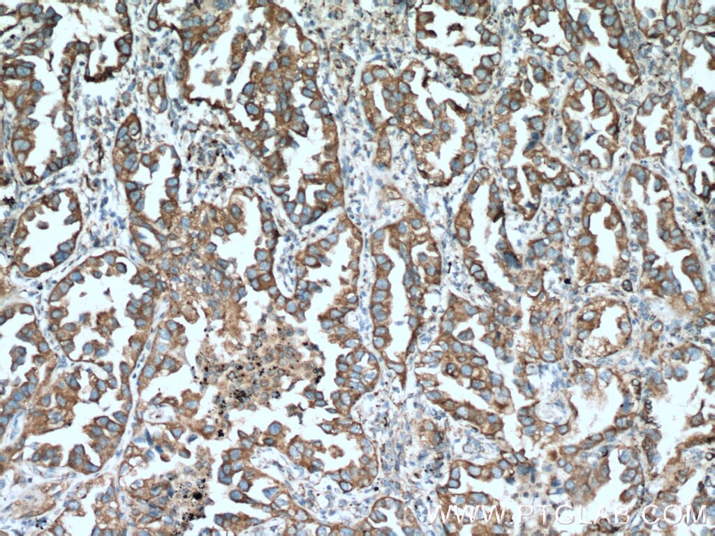 IHC staining of human lung cancer using 15967-1-AP