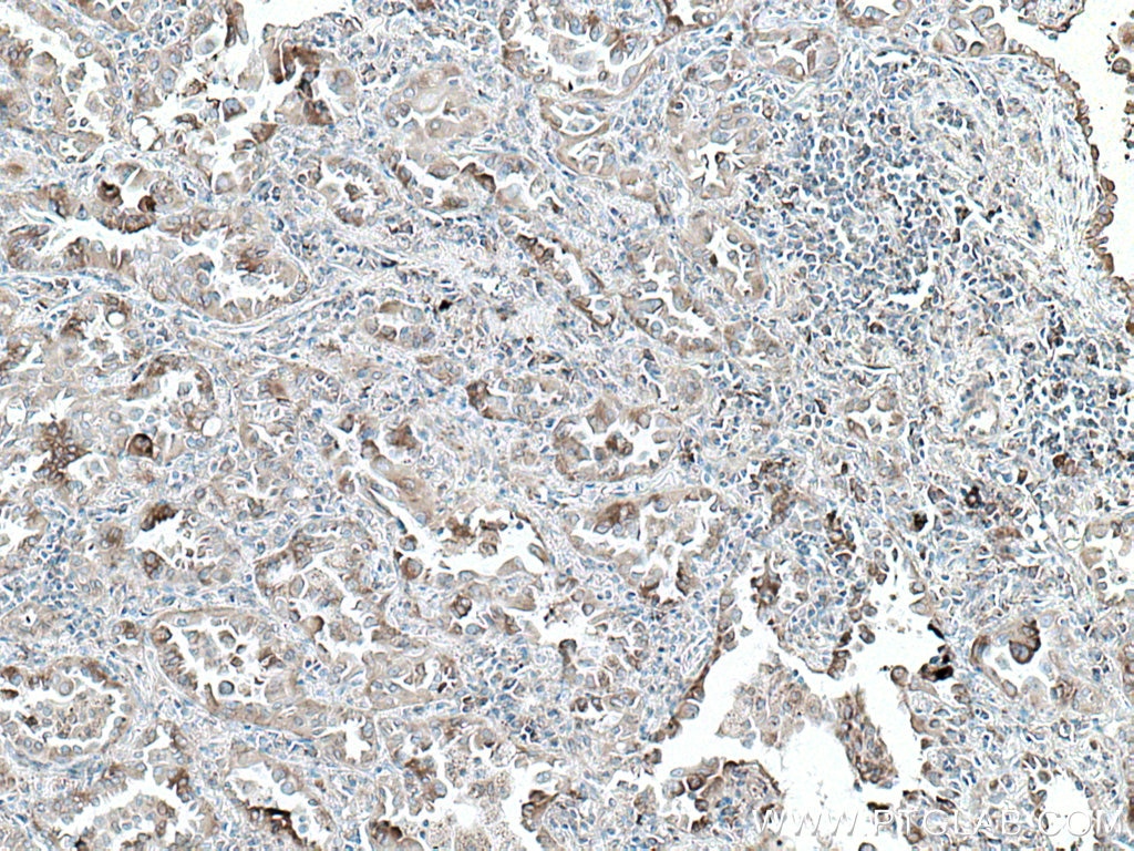 Immunohistochemistry (IHC) staining of human lung cancer tissue using ERp57/ERp60 Monoclonal antibody (66423-1-Ig)