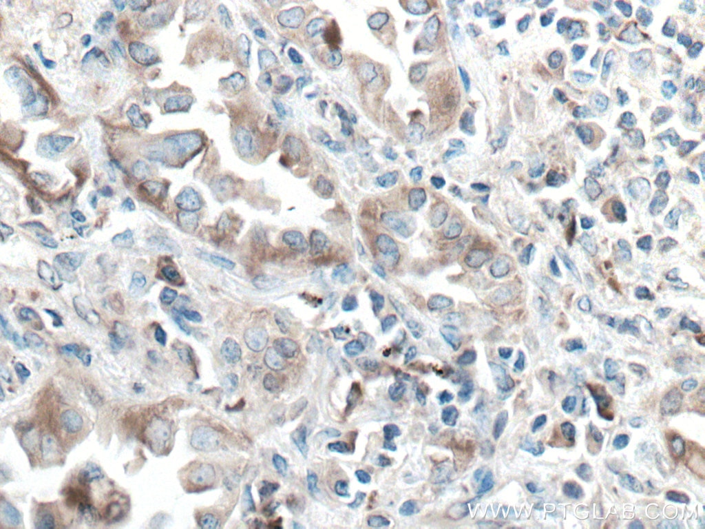 Immunohistochemistry (IHC) staining of human lung cancer tissue using ERp57/ERp60 Monoclonal antibody (66423-1-Ig)