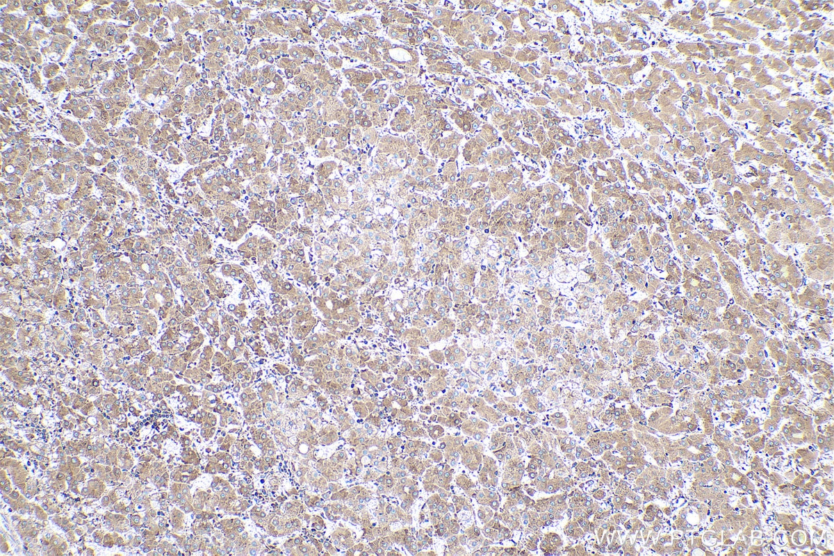 Immunohistochemistry (IHC) staining of human liver cancer tissue using ERp57/ERp60 Monoclonal antibody (66423-1-Ig)