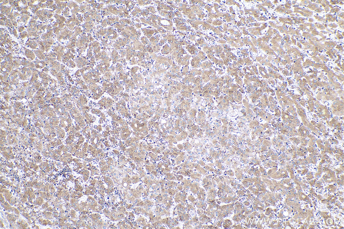 IHC staining of human liver cancer using 66423-1-Ig