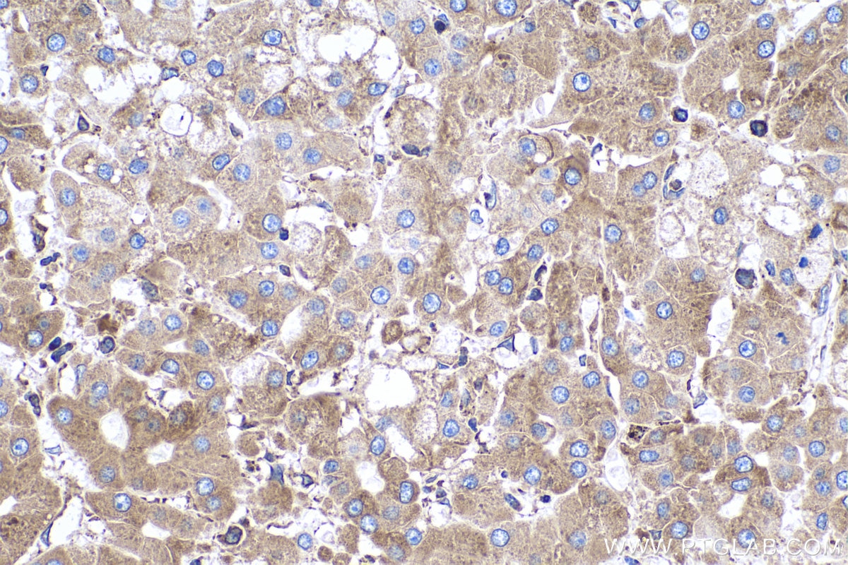 Immunohistochemistry (IHC) staining of human liver cancer tissue using ERp57/ERp60 Monoclonal antibody (66423-1-Ig)