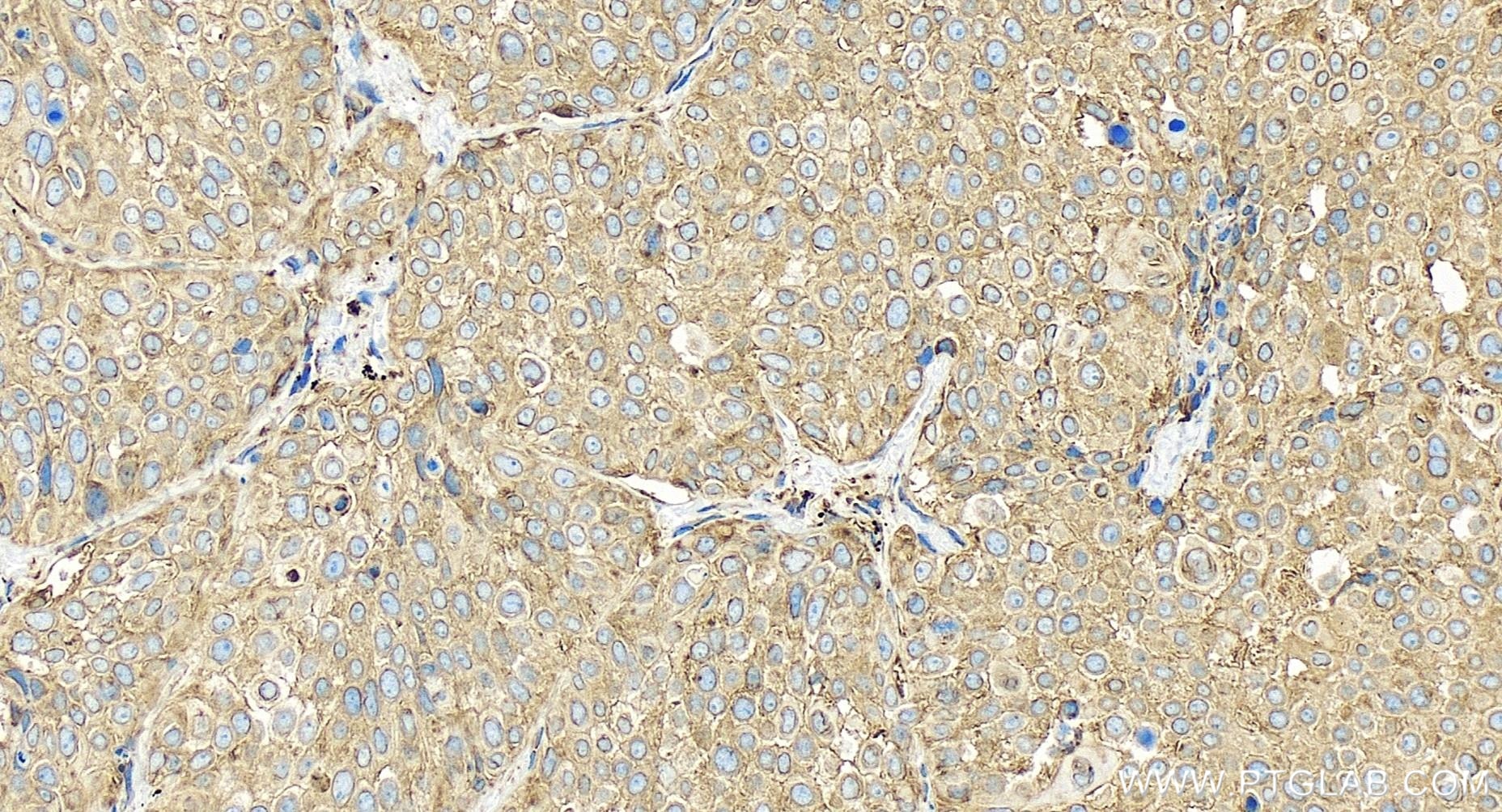 Immunohistochemistry (IHC) staining of human lung cancer tissue using PDIA3 Recombinant antibody (85087-5-RR)
