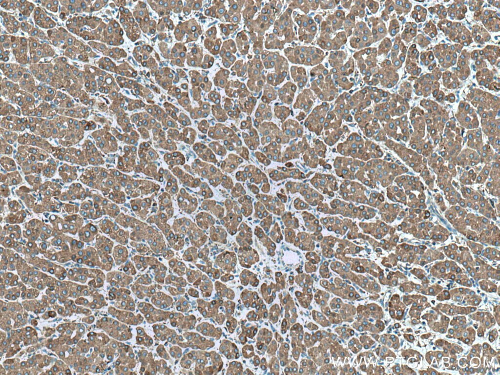 Immunohistochemistry (IHC) staining of human liver cancer tissue using ERp72 Polyclonal antibody (14712-1-AP)