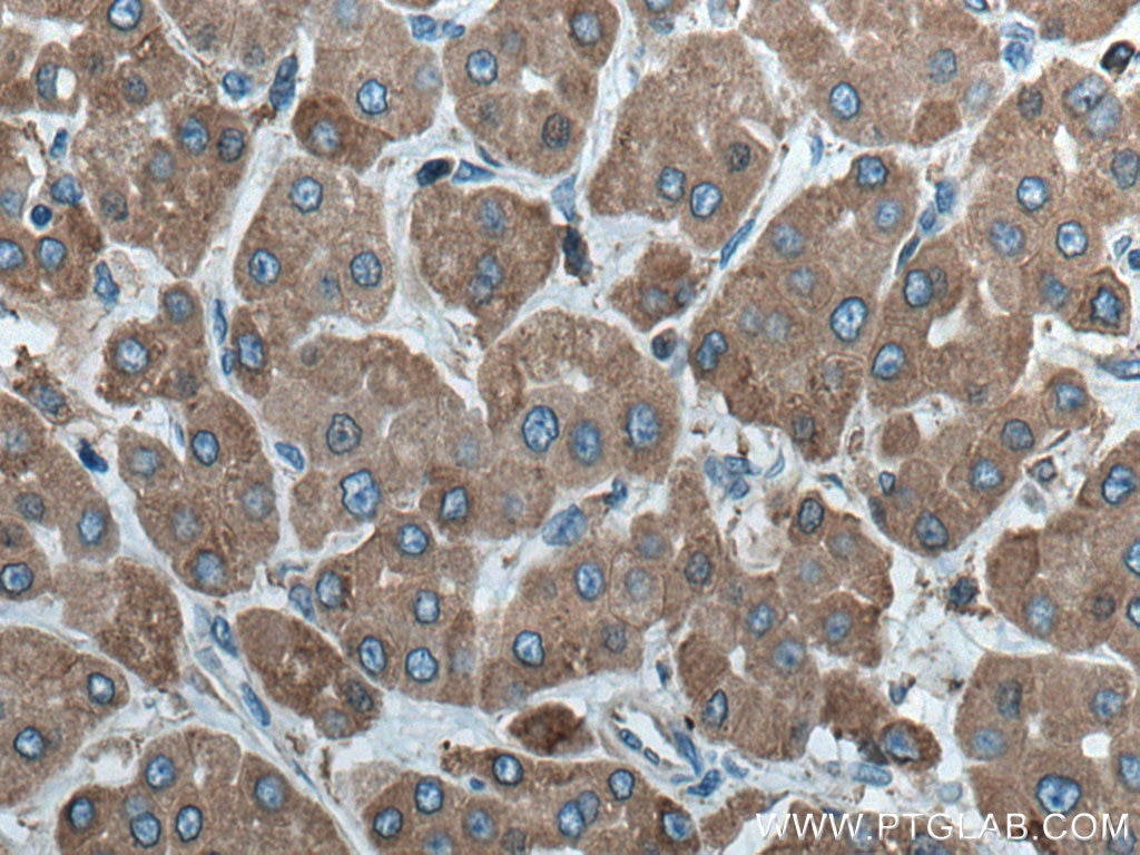 Immunohistochemistry (IHC) staining of human liver cancer tissue using ERp72 Polyclonal antibody (14712-1-AP)
