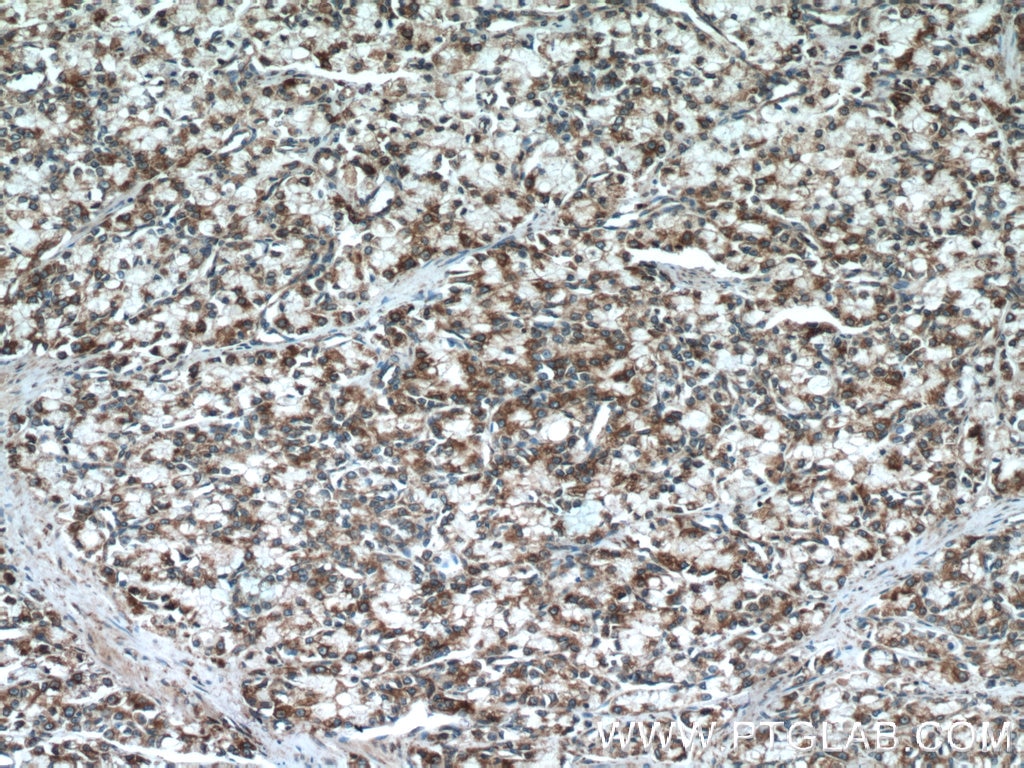 Immunohistochemistry (IHC) staining of human prostate cancer tissue using ERp72 Polyclonal antibody (14712-1-AP)