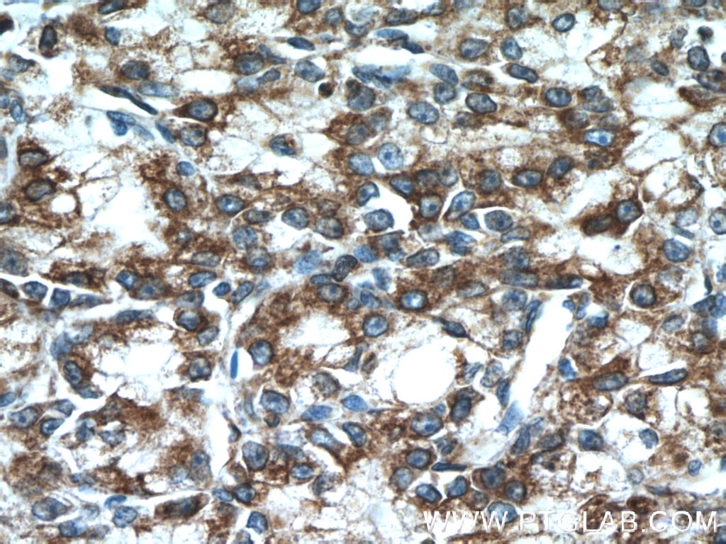 Immunohistochemistry (IHC) staining of human prostate cancer tissue using ERp72 Polyclonal antibody (14712-1-AP)