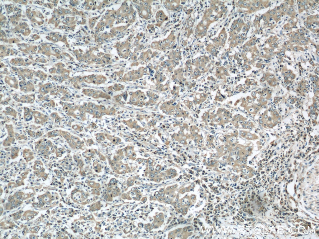 Immunohistochemistry (IHC) staining of human stomach cancer tissue using PDIA6 Polyclonal antibody (18233-1-AP)