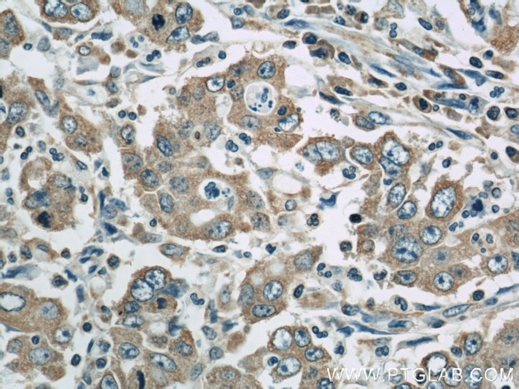 Immunohistochemistry (IHC) staining of human stomach cancer tissue using PDIA6 Polyclonal antibody (18233-1-AP)