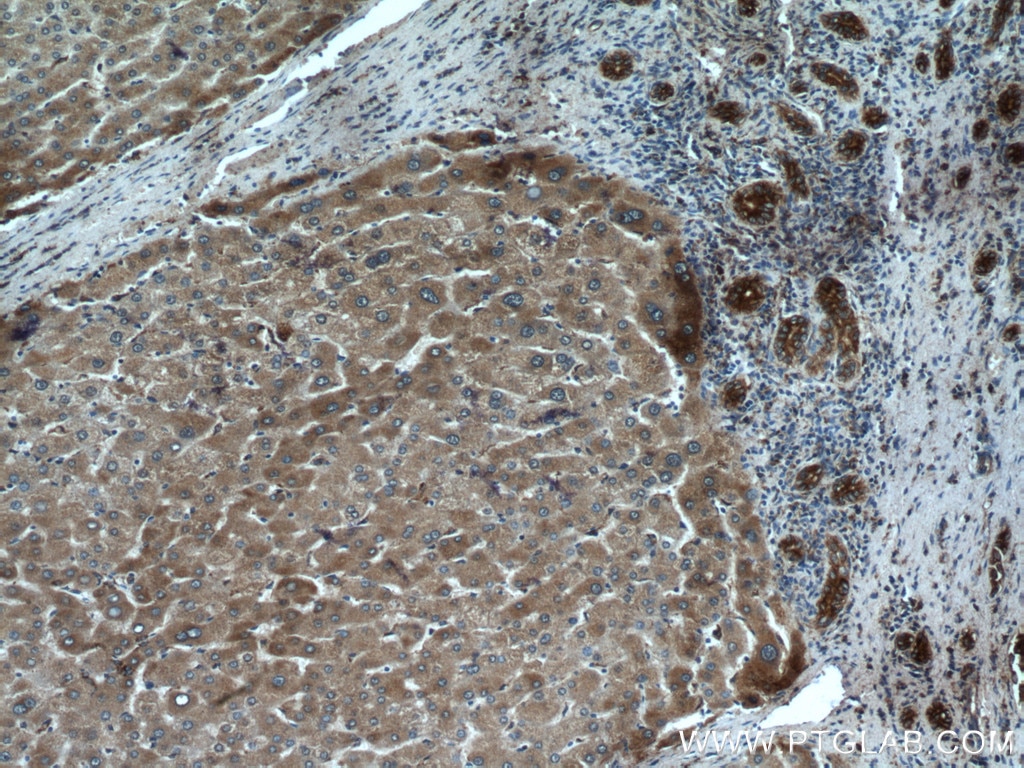 Immunohistochemistry (IHC) staining of human liver cancer tissue using PDIA6 Monoclonal antibody (66669-1-Ig)