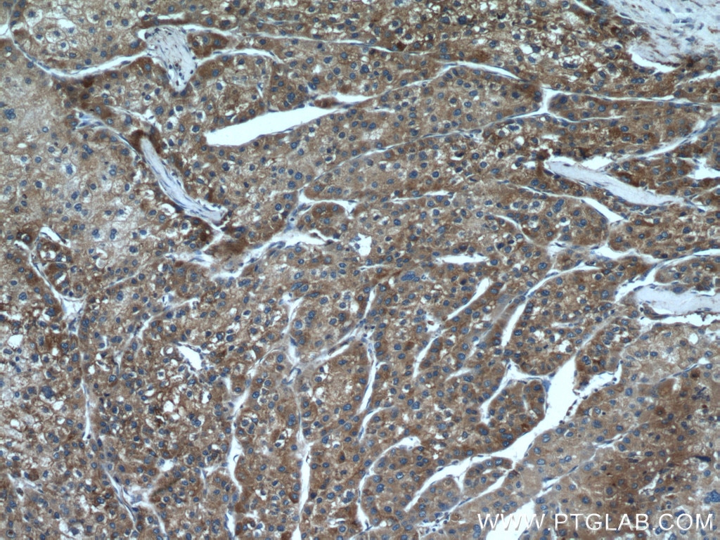 Immunohistochemistry (IHC) staining of human liver cancer tissue using PDIA6 Monoclonal antibody (66669-1-Ig)